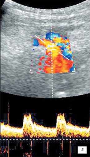 УЗИ в режиме ЦДК - кровоток в почечной артерии вне зоны мальформации