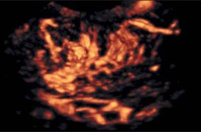 Рак шейки матки - ультразвуковая трехмерная ангиография
