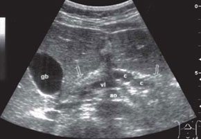 Эхограмма поджелудочной железы ребенка с тяжелым течением муковисцидоза