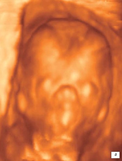 Лицо плода при беременности 13 недель