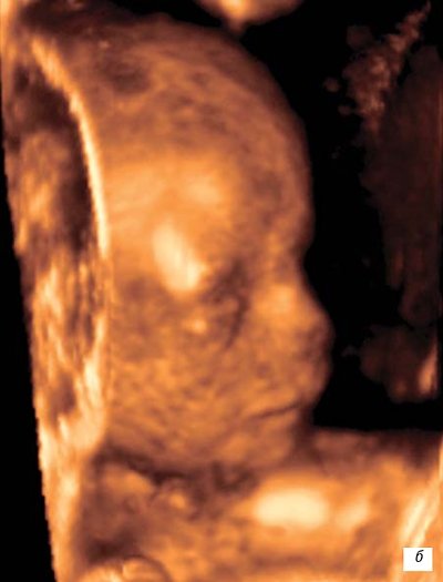 Лицо плода при беременности 14 недель