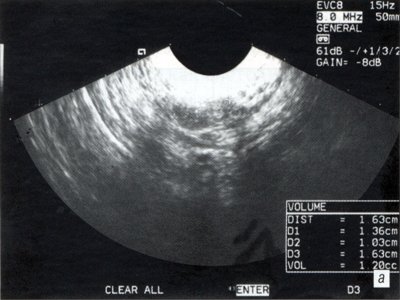 Эхография органов малого таза - правый яичник до лечения