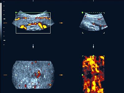 Плацента - режим энергетического допплера