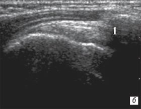 Сонограмма плечевого сустава