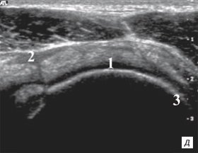 Сонограмма надостной, подостной и двуглавой мышц
