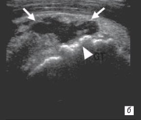 Сонограмма плечевого сустава - фокальный дефект