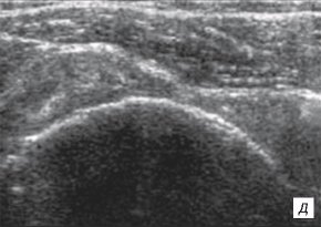 Сонограмма плечевого сустава - грыжевое выпячивание дельтовидной мышцы