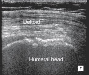 Сонограмма плечевого сустава - соустья с расширенной субакромиально-субдельтовидной бурсой