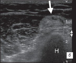 Частичный разрыв сухожилия двуглавой мышцы - атрофическая эхогенность длинной головки мышцы