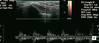 Латеральный эпикондилит, допплер