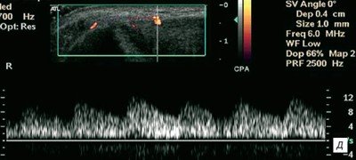 Латеральный эпикондилит, режим допплерографии