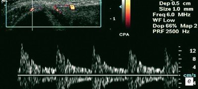 Латеральный эпикондилит, режим допплерографии