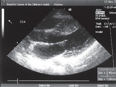 ЭхоКГ ребенка с гипертрофической кардиомиопатией