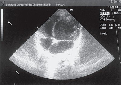 ЭхоКГ ребенка с дилатационной кардиомиопатией