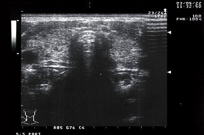 Щитовидная железа ребенка с дилатационной кардиомиопатией - поперечное сканирование