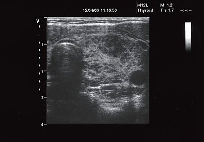 Щитовидная железа ребенка с аутоиммунным тиреоидитом и дилатационной кардиомиопатией - поперечное сканирование