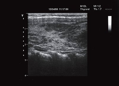 Щитовидная железа ребенка с аутоиммунным тиреоидитом и дилатационной кардиомиопатией - продольное сканирование