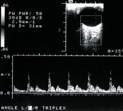 Допплерография глазничной артерии