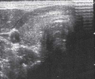 Эхограмма узла щитовидной железы через 2 года после лечения озоном
