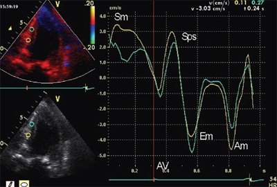 Тканевая допплерография в норме. У больного с постинфарктным кардиосклерозом регистрируется высокоамплитудный пик постсистолической скорости (Sps)
