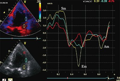Тканевая допплерография при постинфарктном кардиосклерозе. У больного с постинфарктным кардиосклерозом регистрируется высокоамплитудный пик постсистолической скорости (Sps)