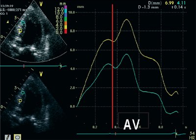 Ступень - формы кривых движения миокарда с постинфарктным кардиосклерозом