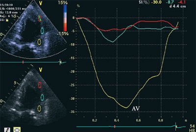 Кривые деформации миокарда при постинфарктном кардиосклерозе
