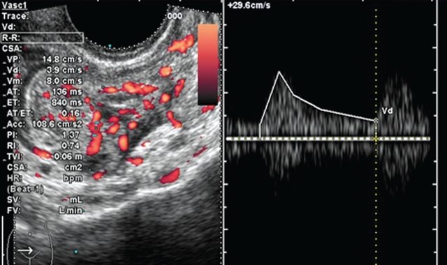 Трансвагинальное УЗИ - режим импульсной допплерографии