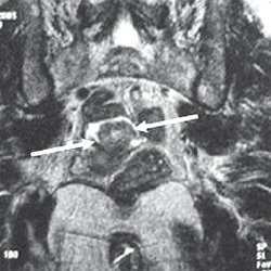 МРТ - опухоль сигмовидной кишки, фронтальная проекция