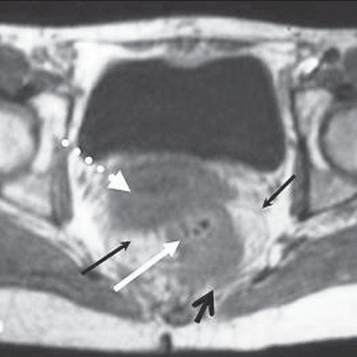МРТ - опухоль сигмовидной кишки, аксиальная проекция