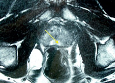 МРТ предстательной железы - стрелкой обозначена зона пониженной интенсивности МР-сигнала