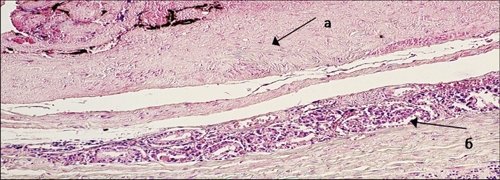 Микропрепарат - рост умеренно дифференцированной аденокарциномы в капсуле предстательной железы (100x)
