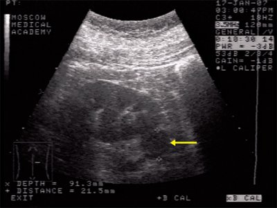 Ультрасонограмма - округлое образование в нижнем сегменте почки