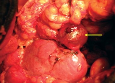 Интраоперационная картина почки