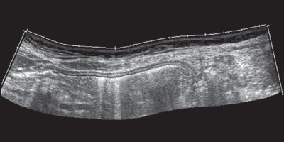Эхограмма - стенки желудка без контрастирования жидкостью (панорамное сканирование)