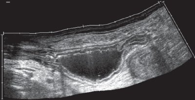 Эхограмма - стенки неизмененного желудка при контрастировании жидкостью (панорамное сканирование)