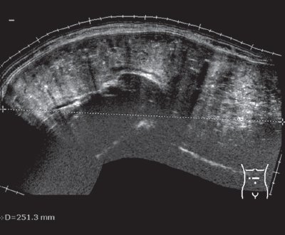 Эхограмма - стеноз выходного отдела желудка, полость желудка переполнена содержимым (панорамное сканирование)