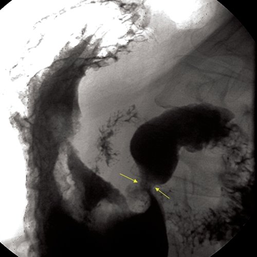 Рентгенограмма - рак антрального отдела желудка