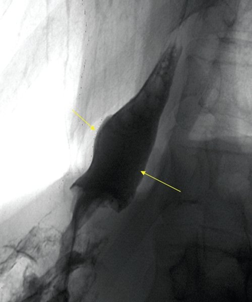 Рентгенограмма - рак проксимального отдела желудка с переходом на пищевод