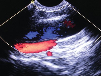 Нормальное расположение и размеры внутренней яремной вены и сонной артерии при исследовании в продольном сечении
