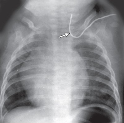 Рентгенография - некорректная позиция центрального венозного катетера, установленного через подключичную вену (катетер расположен против тока крови во внутренней яремной вене)
