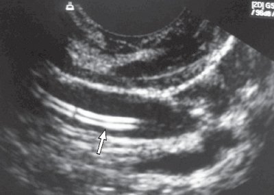 Центральный венозный катетер в просвете внутренней яремной вены (продольное сканирование)