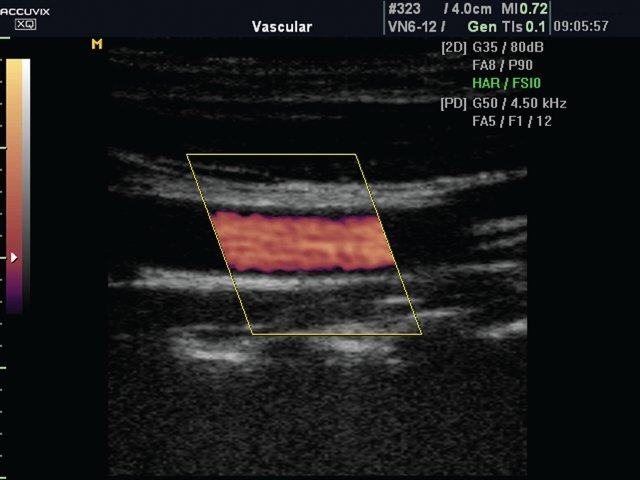 Цветное картирование потока крови - неравномерное утолщение интимы видно значительно лучше