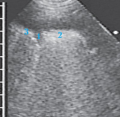Остаточная воздушная полость после острого гнойного абсцесса, гипоэхогенная тонкая стенка (1) отделяет гиперэхогенный сигнал от воздуха в полости (2) от прилежащей легочной ткани (3)