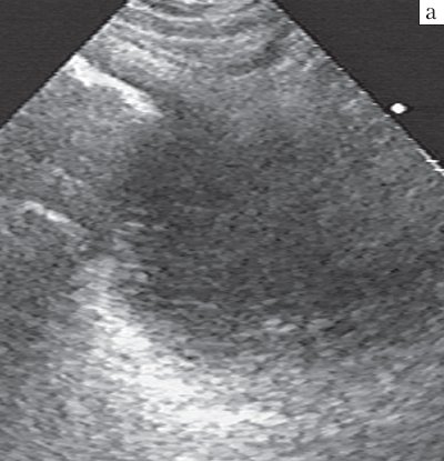 Блокированный острый гнойный абсцесс с однородной эхоструктурой, представленной анэхогенным содержимым с мелкозернистой редкой взвесью