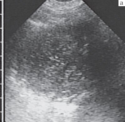 Острый гнойный абсцесс с недостаточным спонтанным дренированием - равномерное диффузное распределение мелких гиперэхогенных включений воздуха на фоне преобладавшего жидкого содержимого
