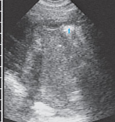 Крупный острый гнойный абсцесс с недостаточным спонтанным дренированием. Плотная взвесь создает псевдосолидную эхоструктуру, на фоне которой у наружной стенки определяется гиперэхогенный сигнал с акустической тенью от воздушного пузыря, еще одно скопление воздуха имеется ближе к нижней границе полости