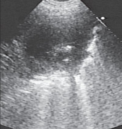 Острый гнойный абсцесс с недостаточным спонтанным дренированием и единичными гиперэхогенными включениями на фоне преимущественно анэхогенного содержимого, пристеночное нарастание эхогенности экссудата вдоль внутренней стенки абсцесса