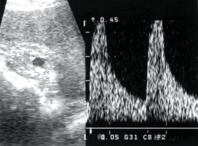 Допплерограмма дольковой артерии паренхимы