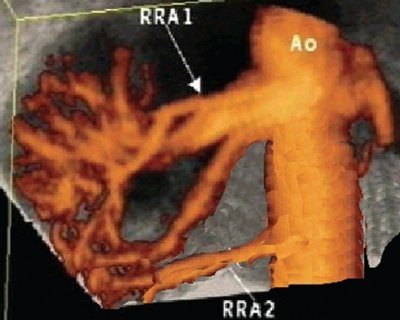 Уретеро-вазальный конфликт вследствие раннего деления основного ствола почечной артерии правой почки - трехмерная ультразвуковая ангиография с диуретической нагрузкой (комбинация режимов MIP и MIN)